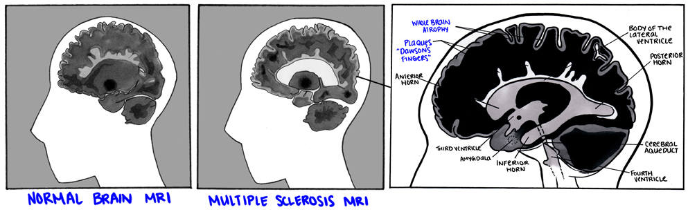 Brain MRI of normal and person with MS