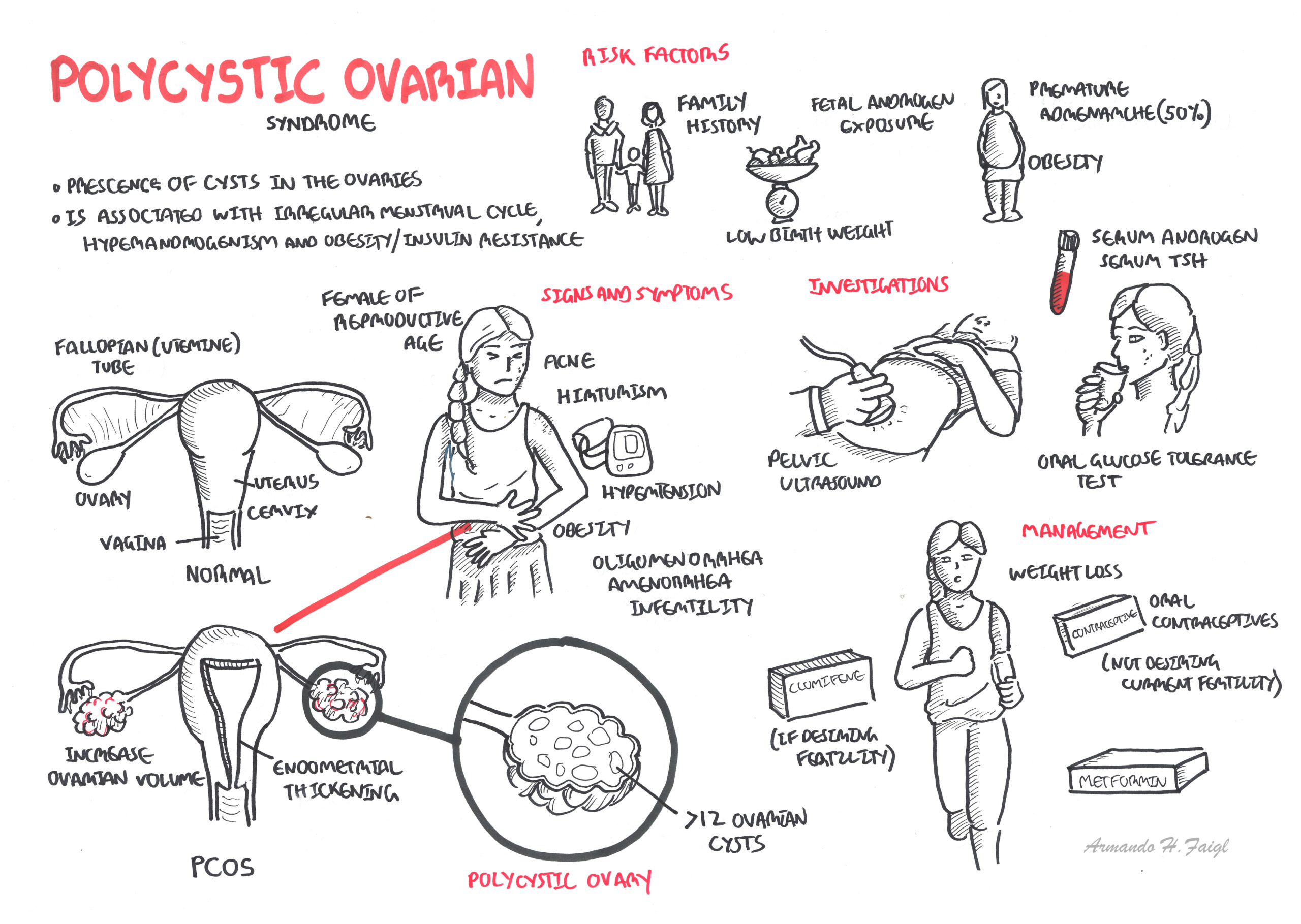 Polycystic Ovarian Syndrome Armando Hasudungan