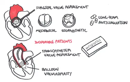Management of Aortic Stenosis depends on operable and inoperable patients. For symptomatic oeprable patients, valve replacement is advised. For young patients, mechanical valve is suggested because of durability.