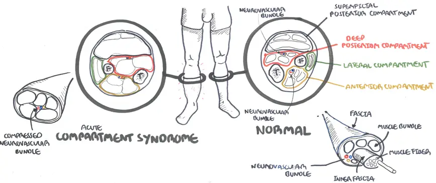Compartment Syndrome - What Exactly It Is? - By Dr. Gautam Das