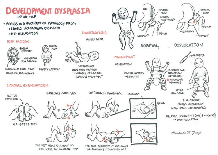 congenital hip dysplasia