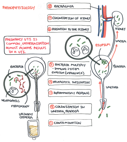 Pathophysiology Of Pyelonephritis In Flow Chart