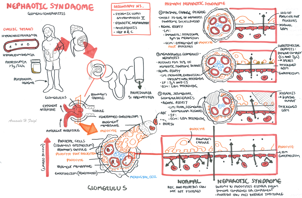 Nephrotic Syndrome | Armando Hasudungan