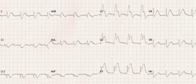 ECG-Ostial-LAD-occlusion-septal-STEMI-2-1024x440
