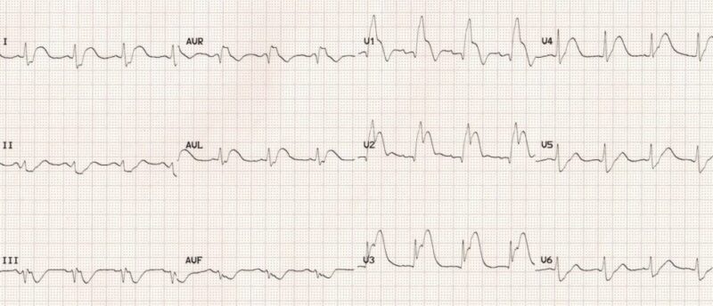 ECG-Ostial-LAD-occlusion-septal-STEMI-2-1024x440