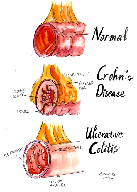 Histological Difference between Crohn Disease and Ulcerative Colitis