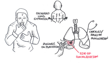 Pneumonia - Armando Hasudungan