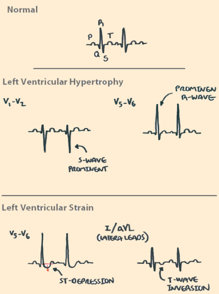 Aortic Stenosis - Armando Hasudungan