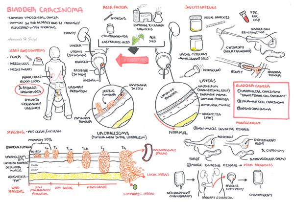 bladder-carcinoma2