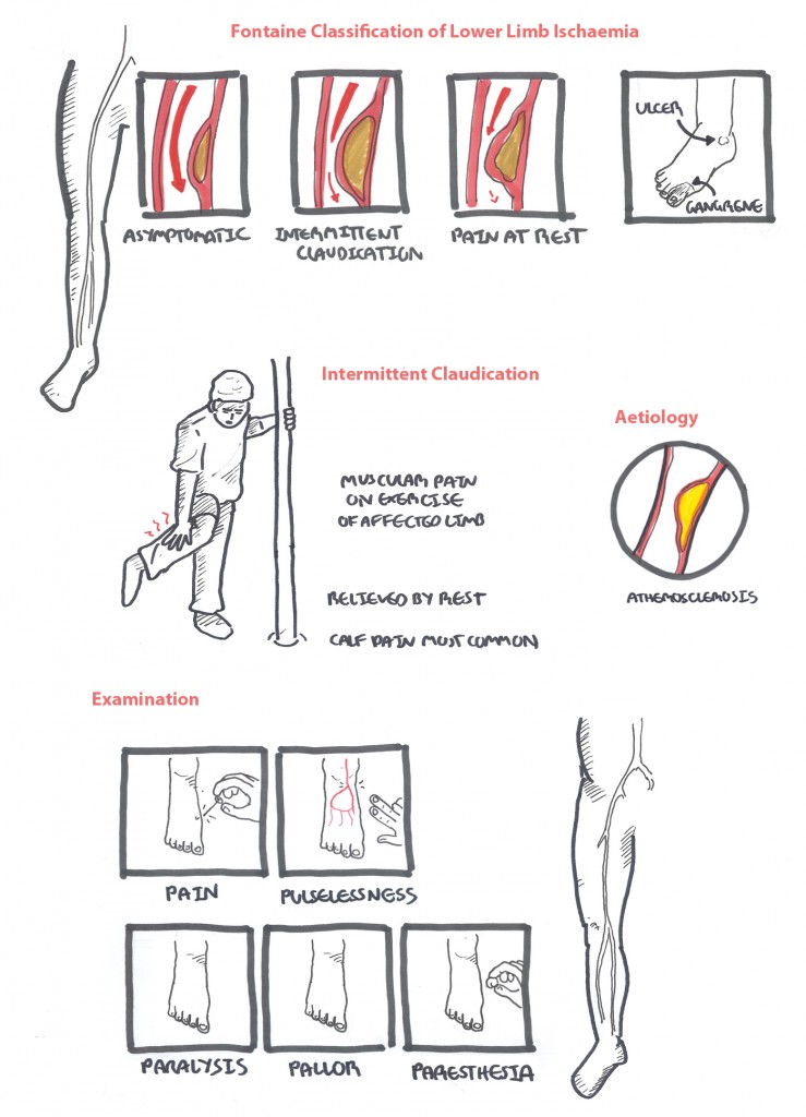 Lower Limb Ischaemia