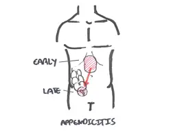 appendicitis