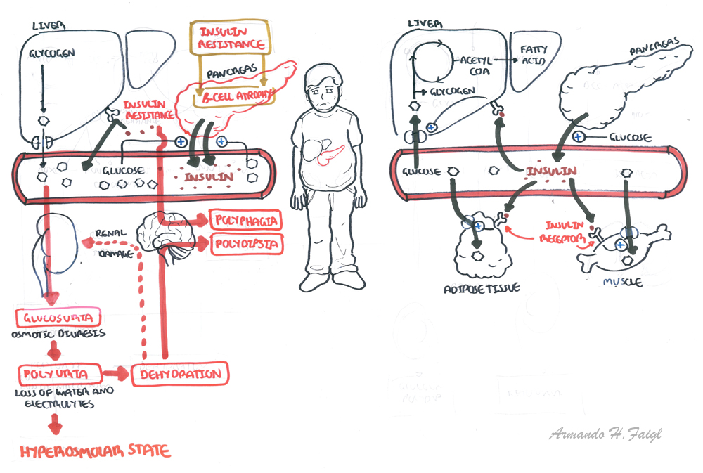 Acute Diabetes Complication (DKA, HHS, Hypoglycaemia) - Armando Hasudungan