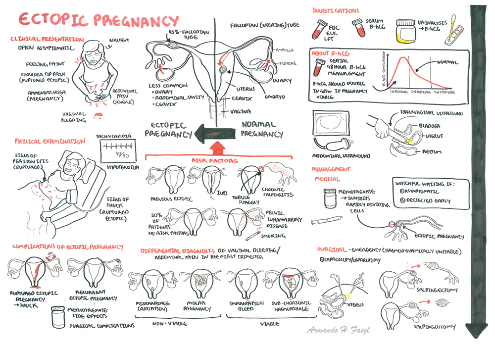 ectopic pregnancy