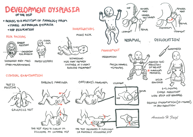 Signs of hip dysplasia in outlet babies