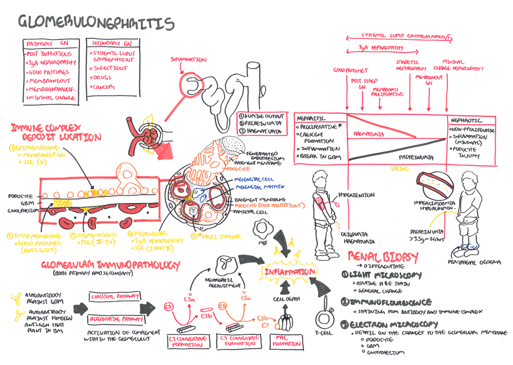 glomerulonephritis images