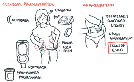 Nephrotic Syndrome | Armando Hasudungan