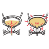 Acute Urinary Retention – Armando Hasudungan