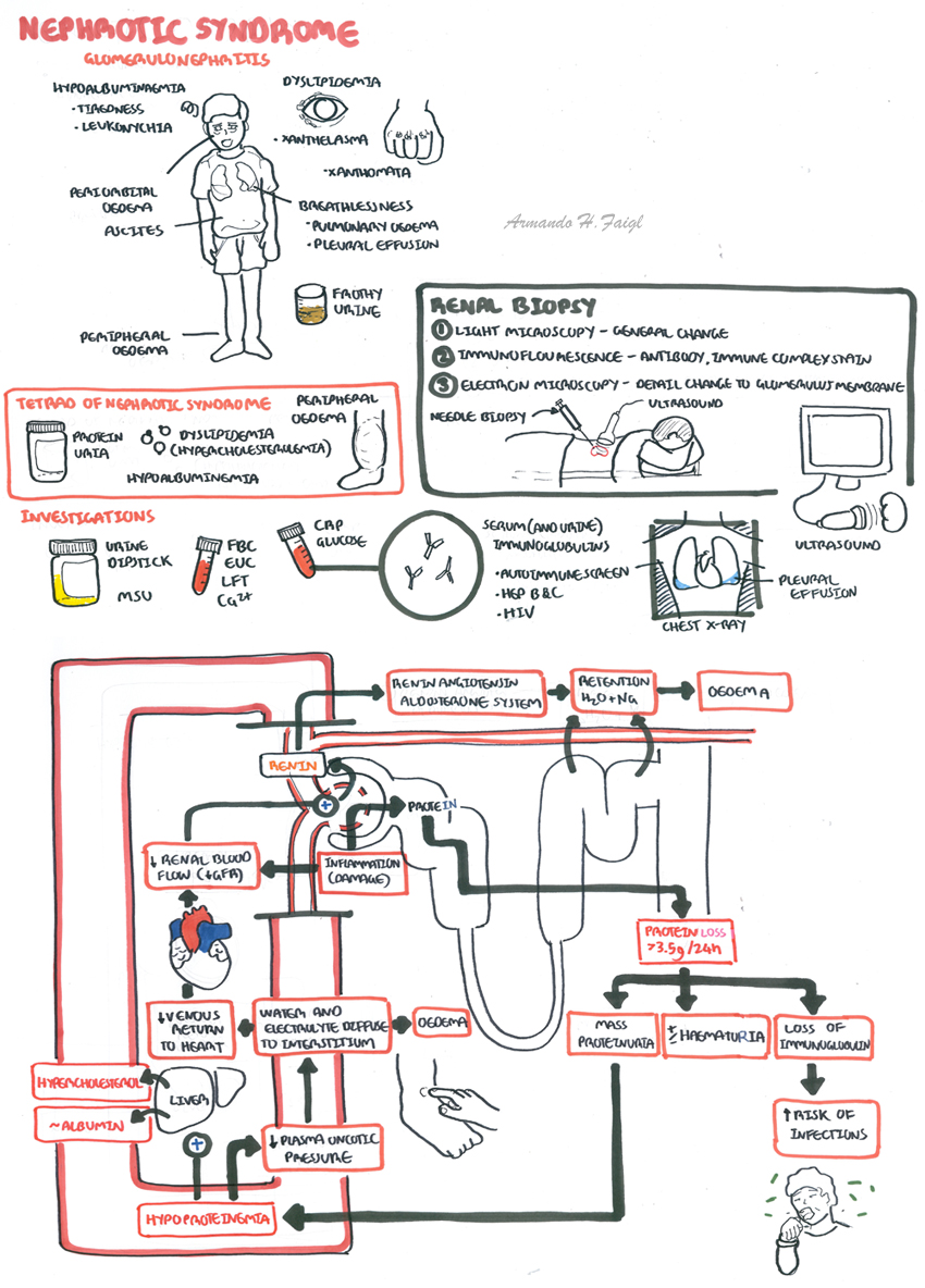 Nephrotic Syndrome | Armando Hasudungan