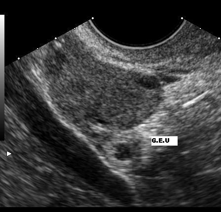 Ultrasound demonstrating an ectopic pregnancy.