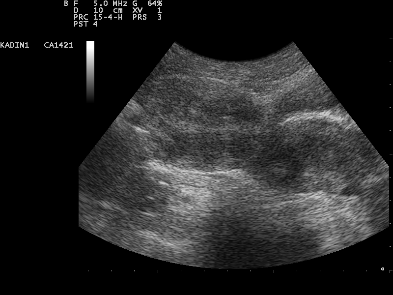 Pelvic ultrasound demonstrating an ovary affected by torsion.