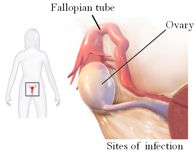 Diagram showing tubo-ovarian abscesses involving the ovary and fallopian tube.