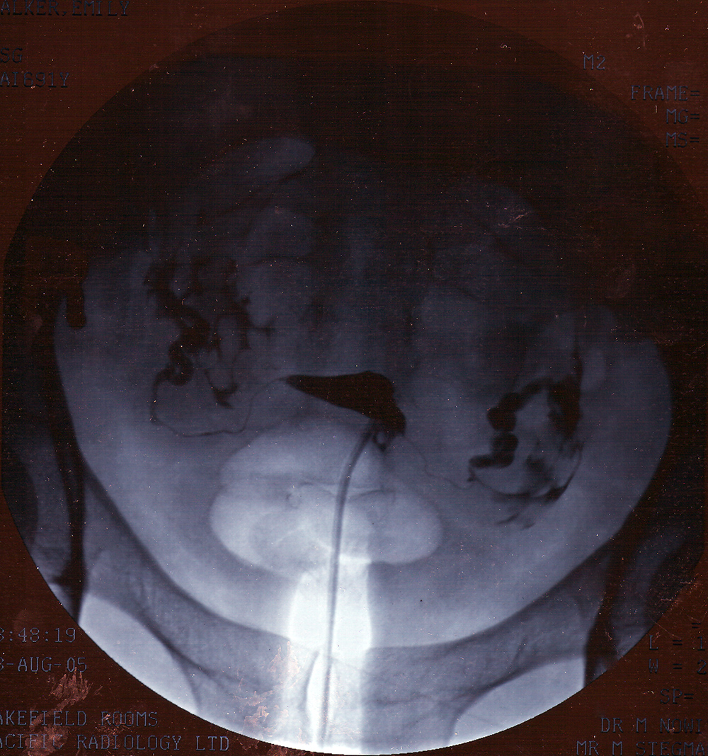 Contrast hysterosalpingogram showing the uterine cavity and bilateral fallopian tubes.