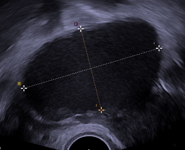 Transvaginal ultrasound demonstrating an ovarian endometrioma with homogeneous internal echoes.