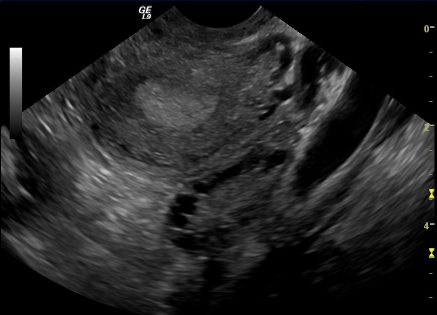 Transvaginal ultrasound showing multiple follicles within a polycystic ovary.