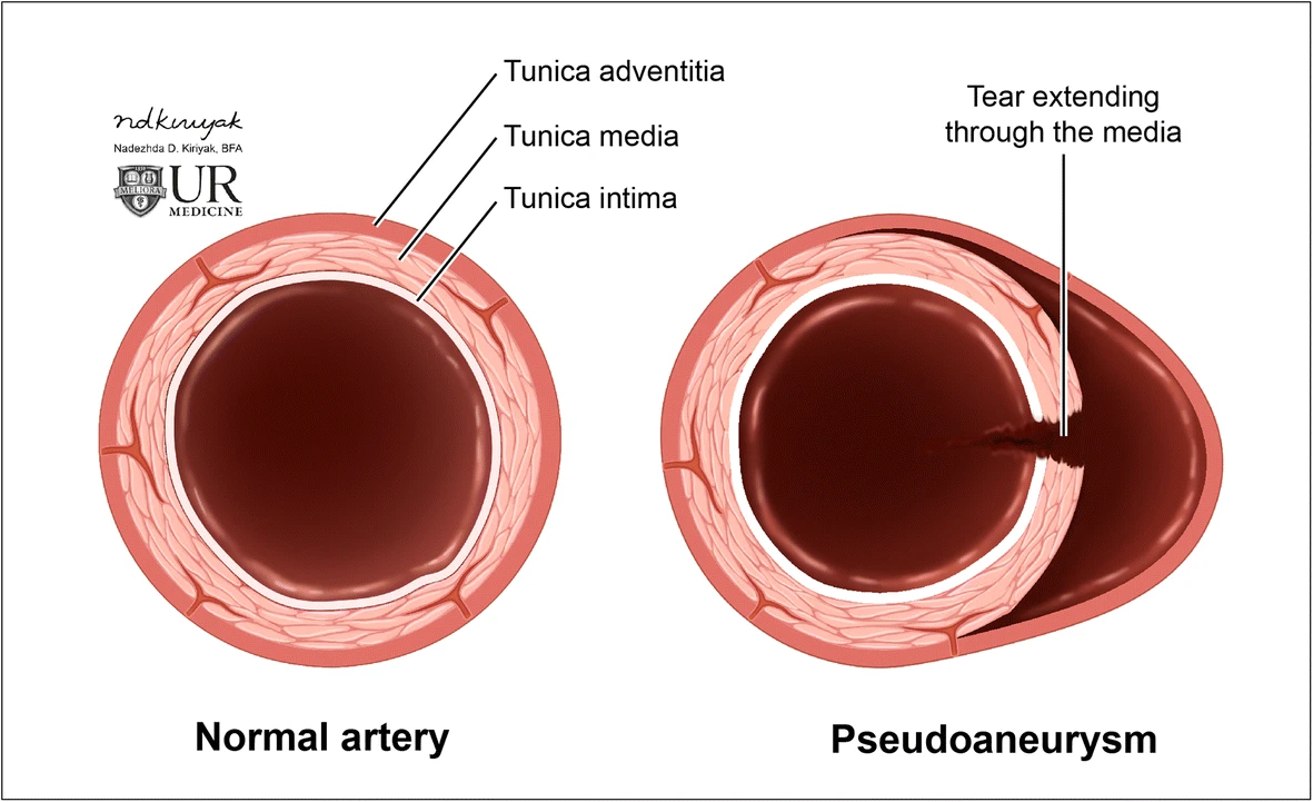 Diagram comparing a normal artery with an arterial pseudoaneurysm caused by disruption of the arterial wall.