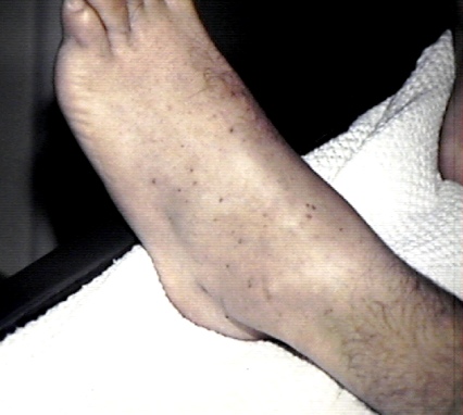 Numerous small red-purple petechiae scattered across the skin.
