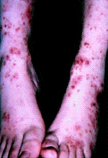 Both lower legs showing raised purple lesions and focal necrosis from cutaneous small-vessel vasculitis.