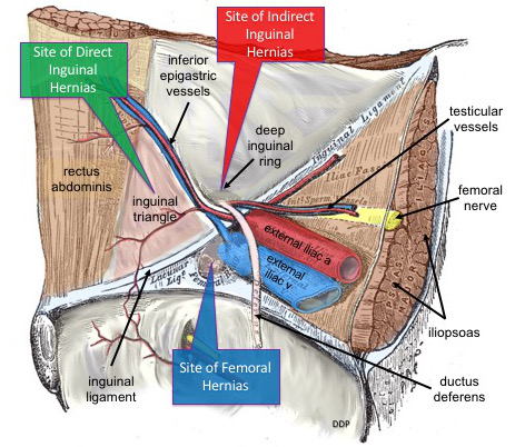 Diagram showing the anatomical locations of direct inguinal, indirect inguinal and femoral hernias.