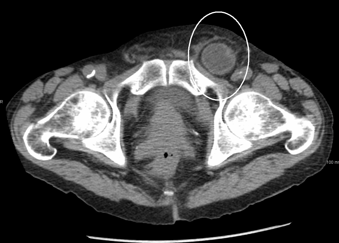 CT image demonstrating an incarcerated inguinal hernia.