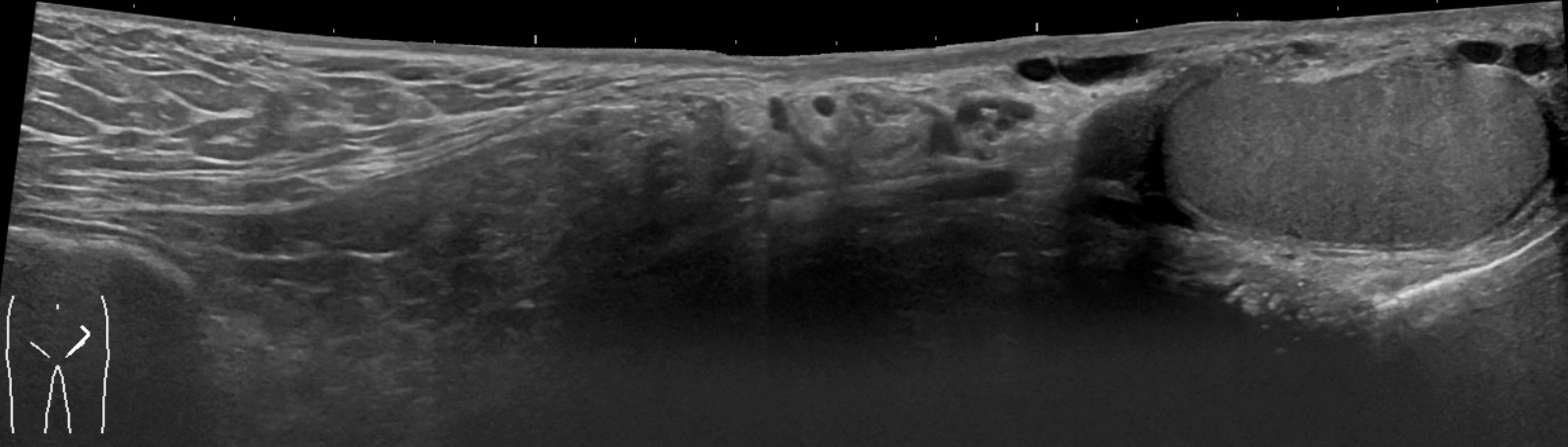 Ultrasound demonstrating a fat-containing indirect inguinal hernia with the testis visible for orientation.