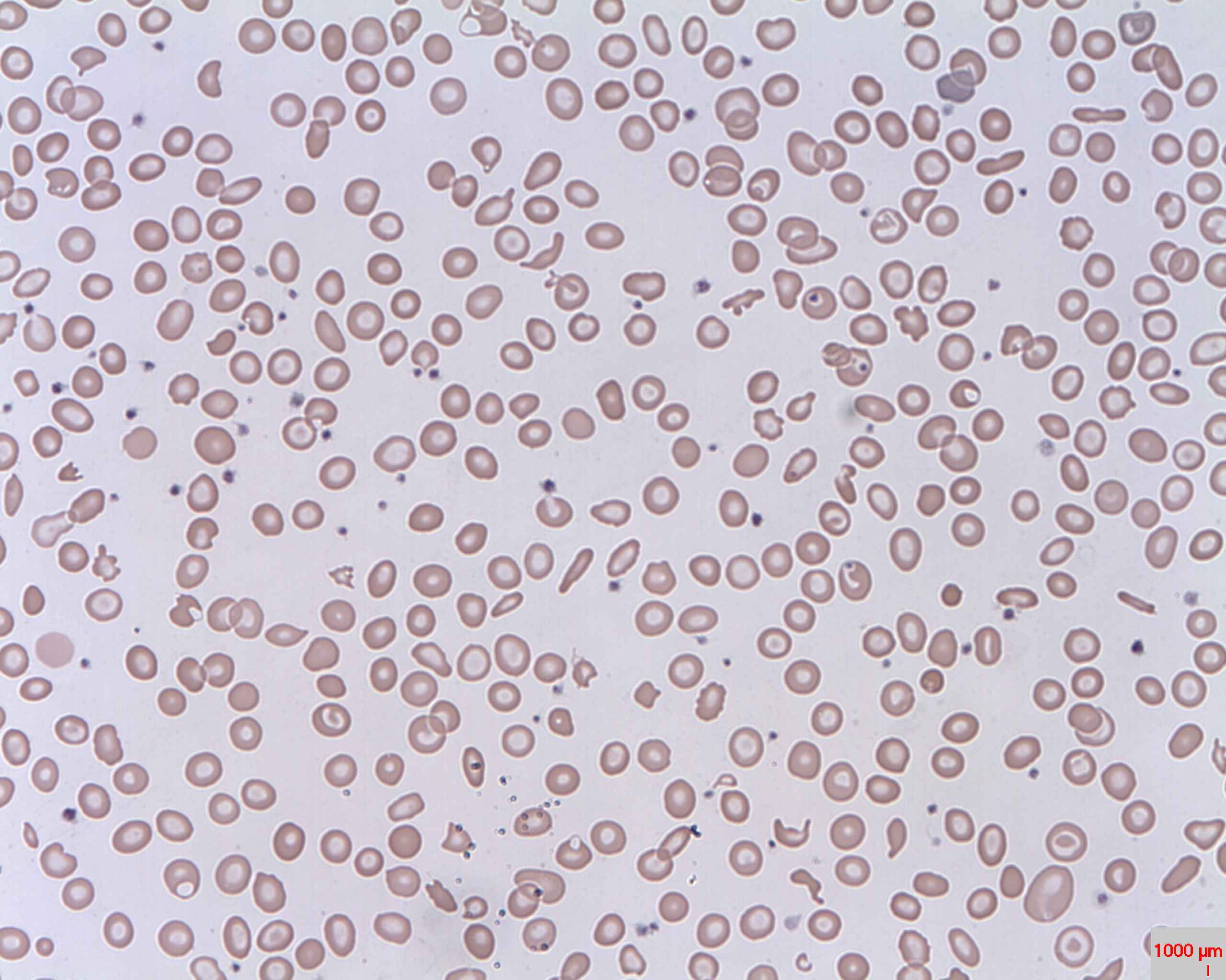 Peripheral blood smear containing multiple fragmented red blood cells called schistocytes.