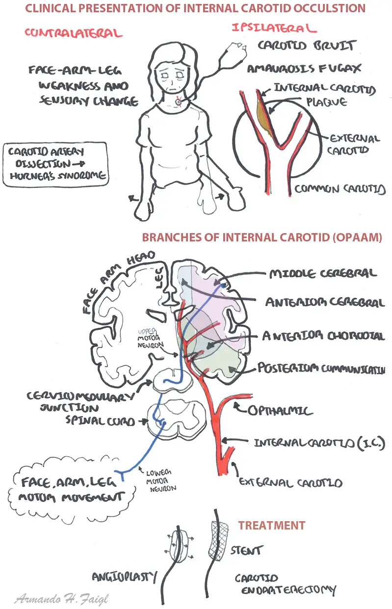 internal carotid occulsion