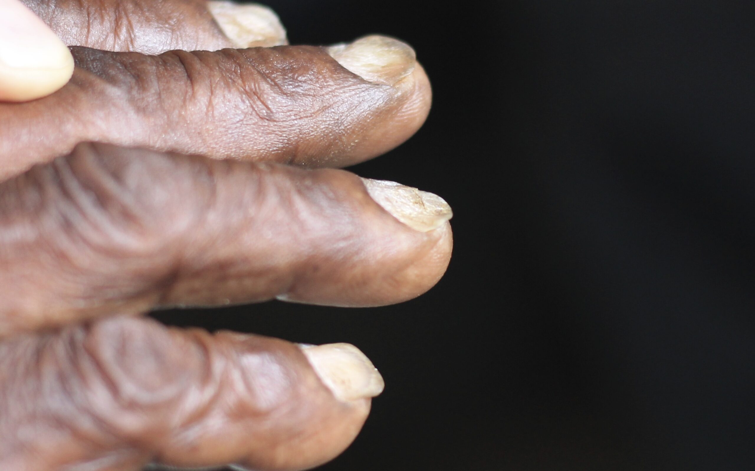 Fingernails with central depression and raised edges demonstrating koilonychia