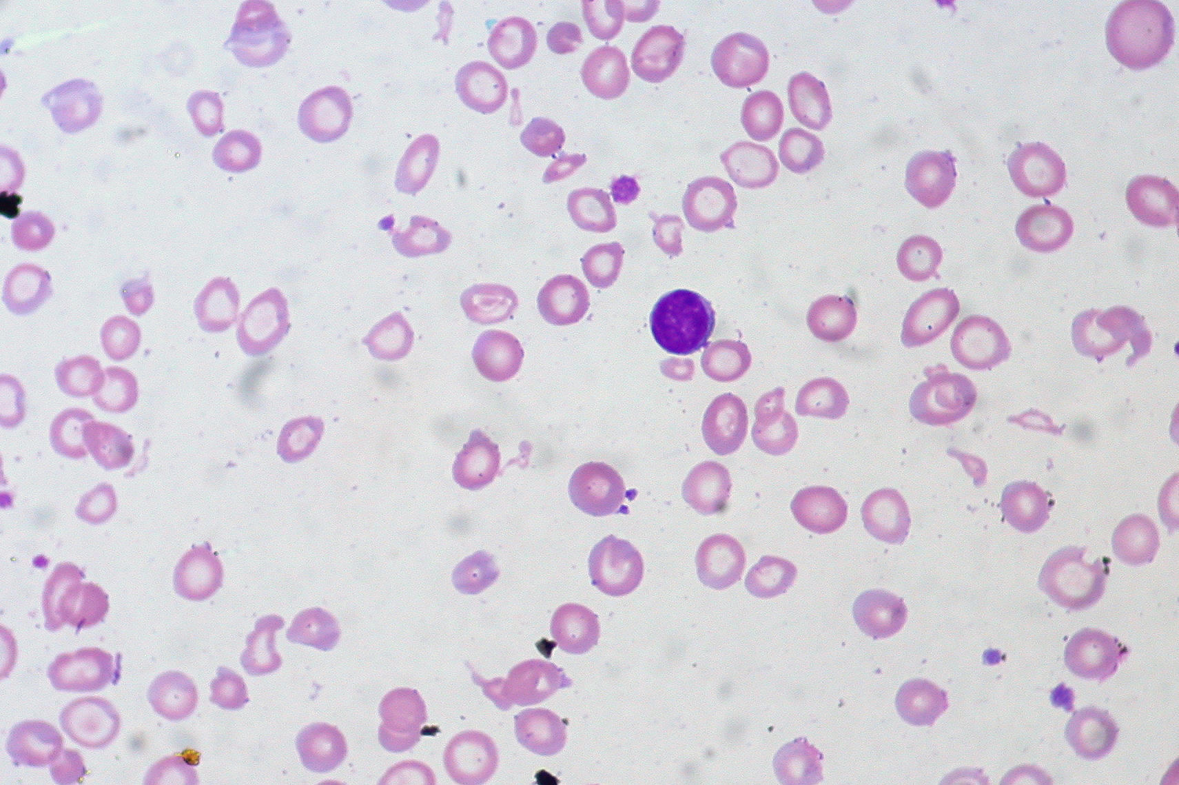 Peripheral blood film showing marked microcytosis and hypochromia in severe iron-deficiency anaemia
