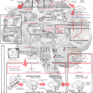 Acute Coronary Syndrome 1/2 - Personal use