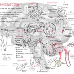 Acute Pancreatitis - Personal use