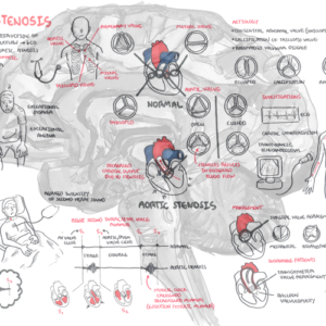 Aortic Stenosis - Personal use