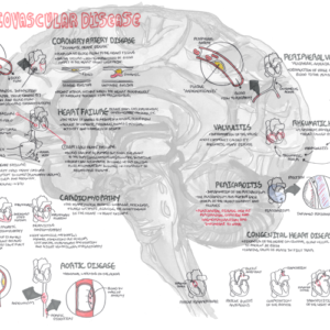 Cardiovascular Disease Overview - Personal use