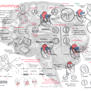 Mitral Regurgitation Overview - Personal use