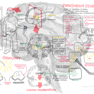 Parkinson's Disease - Personal use