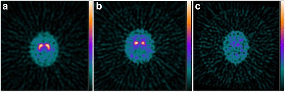 Three dopamine-transporter SPECT scans comparing essential tremor, Parkinson's disease and dementia with Lewy bodies.