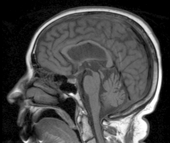 Sagittal brain MRI showing midbrain atrophy and preserved pons in progressive supranuclear palsy.