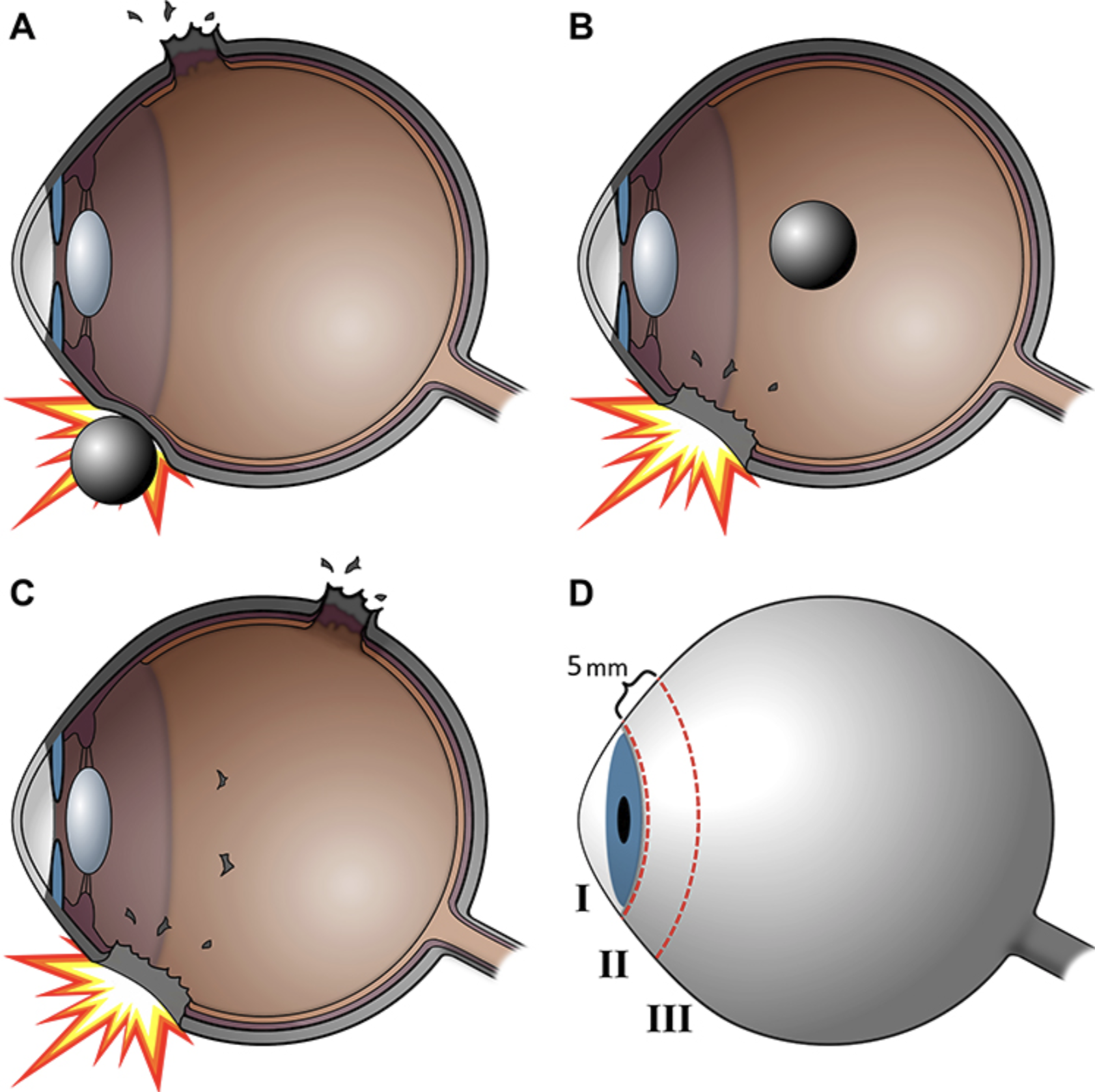Cross-sectional diagrams comparing globe rupture from blunt trauma with penetrating and perforating open-globe injuries.