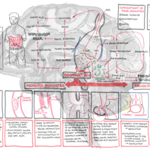 Bowel Obstruction - Pathophysiology - Personal use