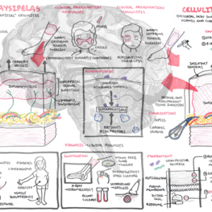 Cellulitis and erysipelas - Overview - Personal use