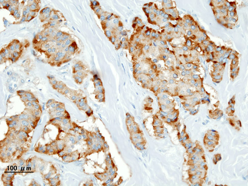 Histological section of pancreatic insulinoma showing positive brown chromogranin A immunostaining